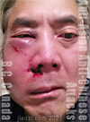 5 hours at VGH  after daylight unprovoked assault, near Metrotown, Burnaby -   by man loudly saying CHINA ..China... China ... results in fractures in face profuse bleeding from nose cut and chipped teeth 